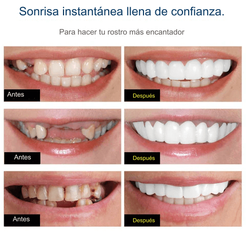 CARILLAS DENTALES